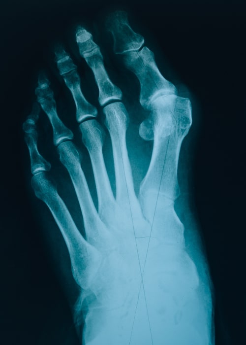 The Chronic Condition Gout is Treatable by ProleevaMax.